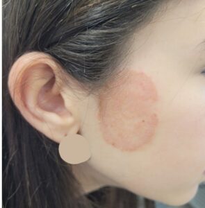 פטריה בעור הפנים בצורת עיגול