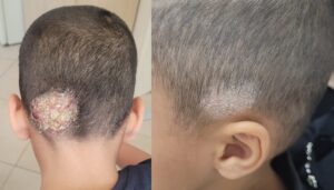 פטריה בקרקפת בילדים