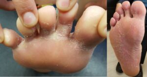פטרת כף הרגל – קילוף בין האצבעות