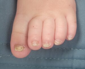 פטרת ציפורניים בילדים